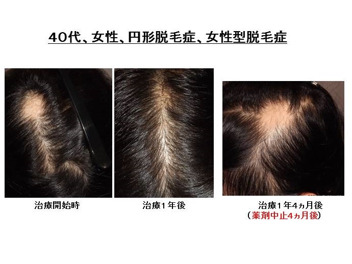 円形脱毛症　病院""